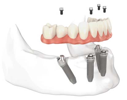 all on 4 dental implants